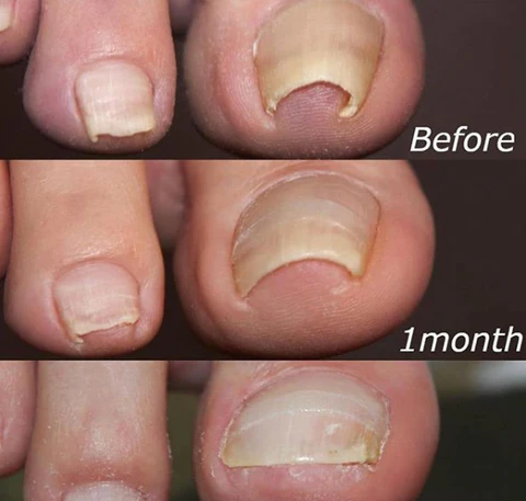 Nail Correction Patches™